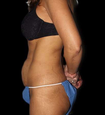 Abdominoplasty (Tummy Tuck) Before & After Patient #757