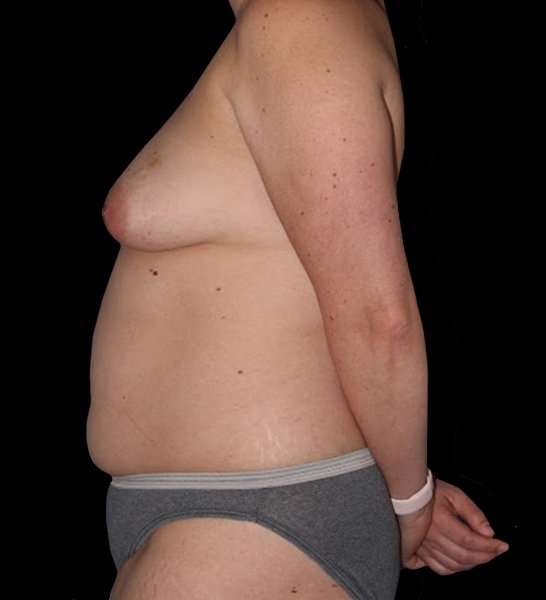 DIEP Flap Before & After Patient #2954