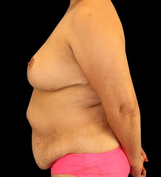 DIEP Flap Before & After Patient #2974