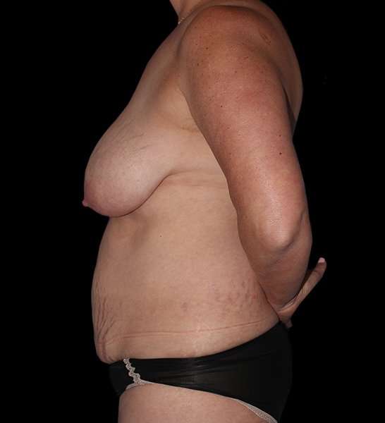 DIEP Flap Before & After Patient #2989