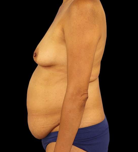 DIEP Flap Before & After Patient #3019