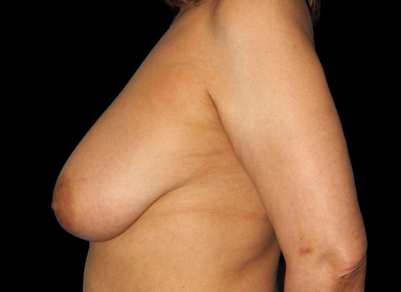 DIEP Flap Before & After Patient #3030