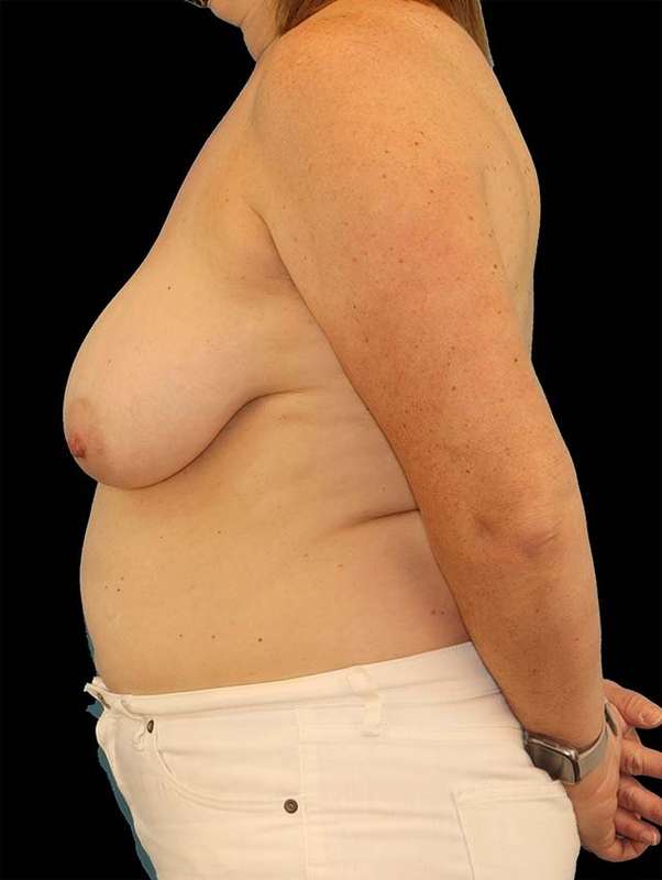 DIEP Flap Before & After Patient #3110