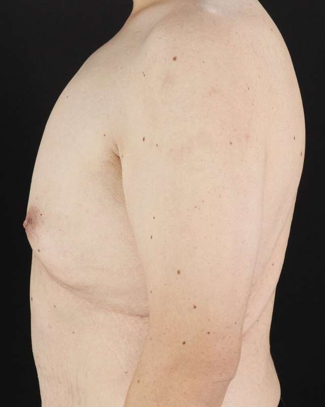 Gynecomastia Before & After Patient #3162