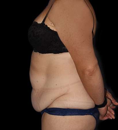 Abdominoplasty (Tummy Tuck) Before & After Patient #768