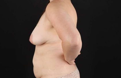 Mastopexy Before & After Patient #3268