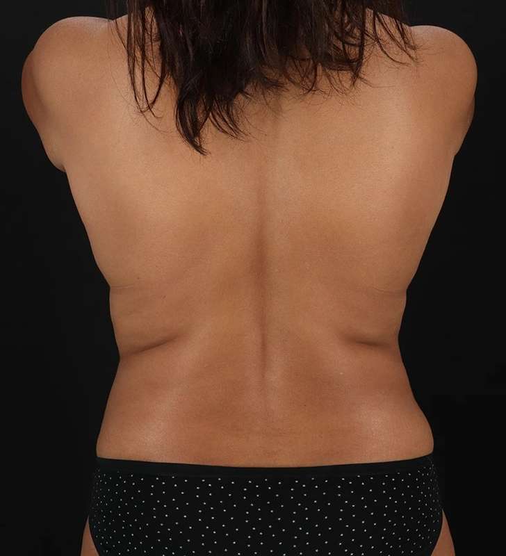 Mastopexy Before & After Patient #3279