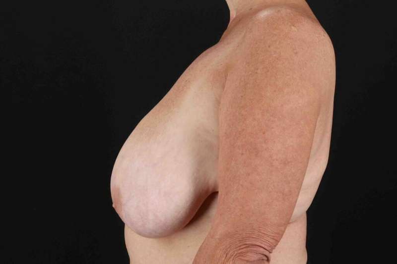 Breast Reduction With Lift Before & After Patient #3312