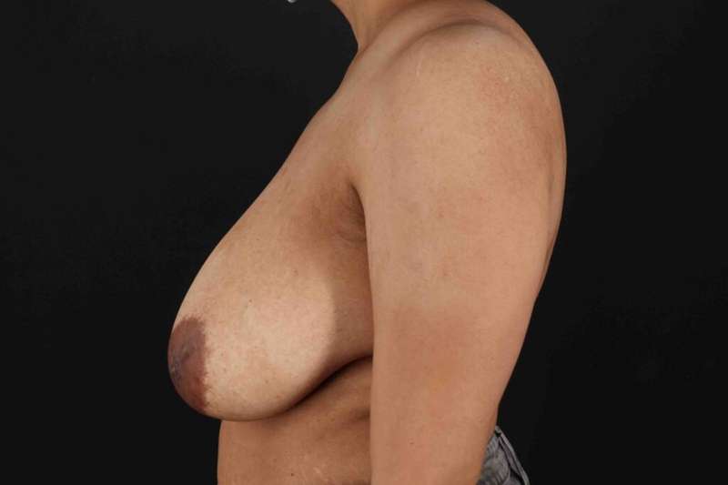Breast Reduction With Lift Before & After Patient #3323