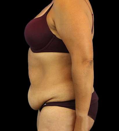 Abdominoplasty (Tummy Tuck) Before & After Patient #779