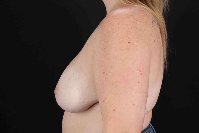 Breast Reduction With Lift Before & After Patient #3367