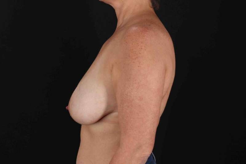Breast Reduction With Lift Before & After Patient #3389