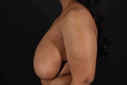 Breast Reduction With Lift Before & After Patient #3400