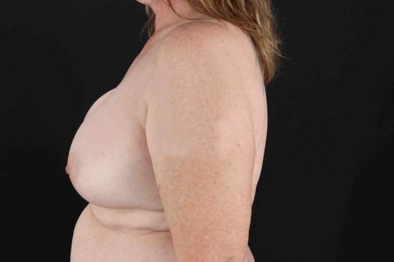 Breast Implant Removal Before & After Patient #3483