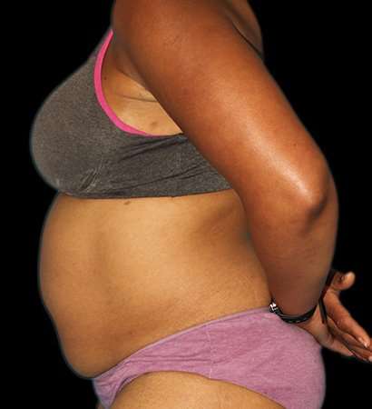 Abdominoplasty (Tummy Tuck) Before & After Patient #790