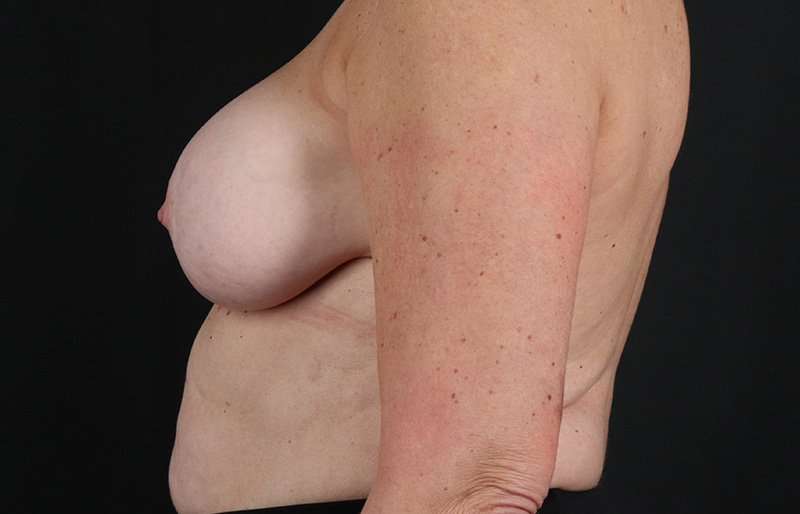 Breast Implant Removal Before & After Patient #3516