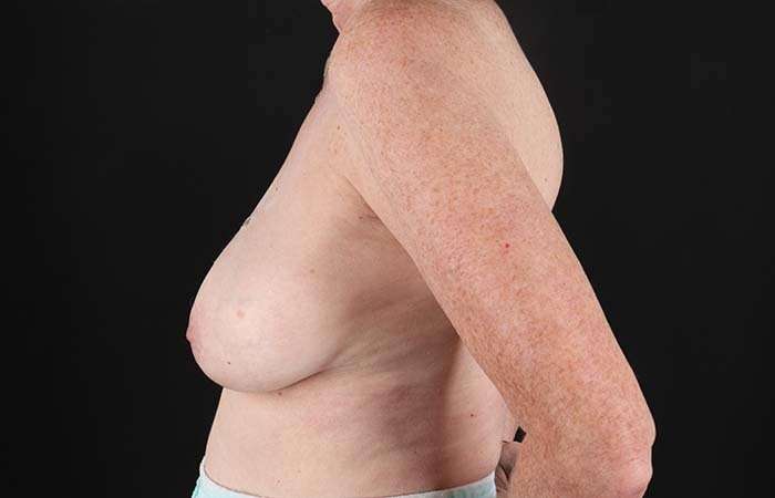 Implant Based Reconstruction Before & After Patient #3527