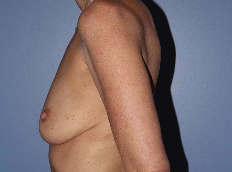 Implant Based Reconstruction Before & After Patient #3538
