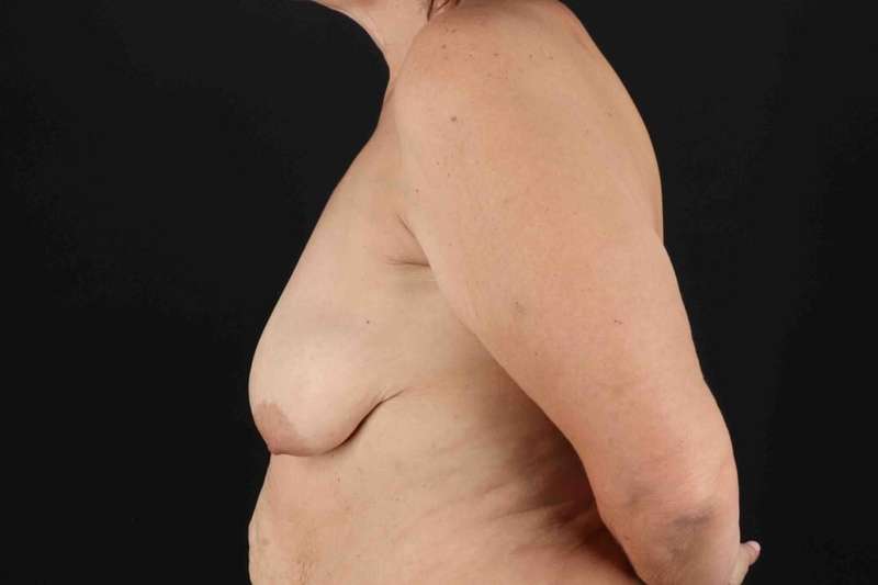 Breast Lift Before & After Patient #3571