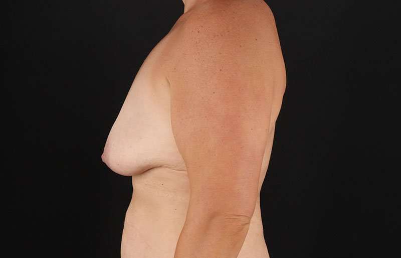 Breast Lift Before & After Patient #3615