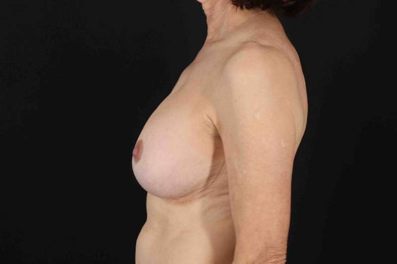 Breast Lift Before & After Patient #3662