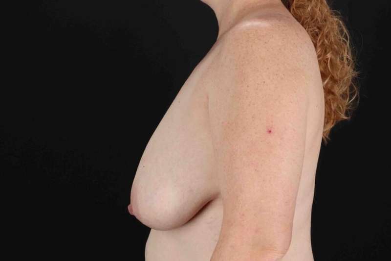 Breast Lift Before & After Patient #3684