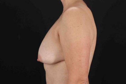 Breast Lift Before & After Patient #3706