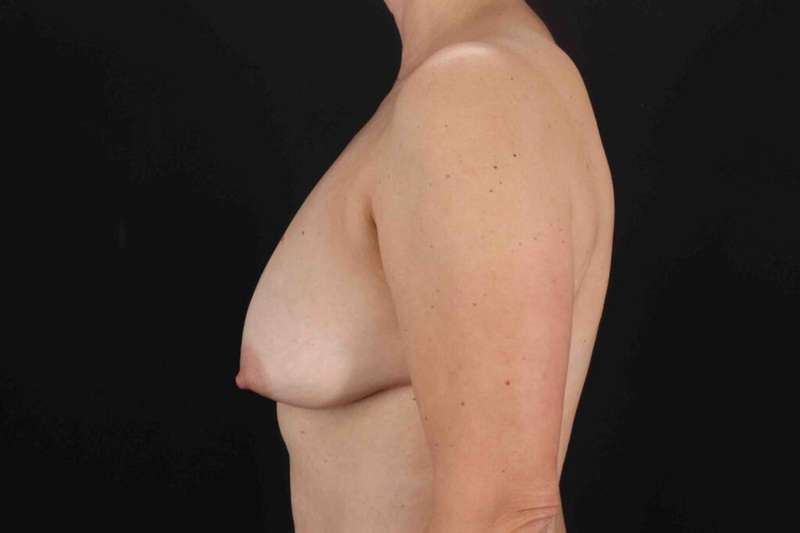 Breast Lift Before & After Patient #3706