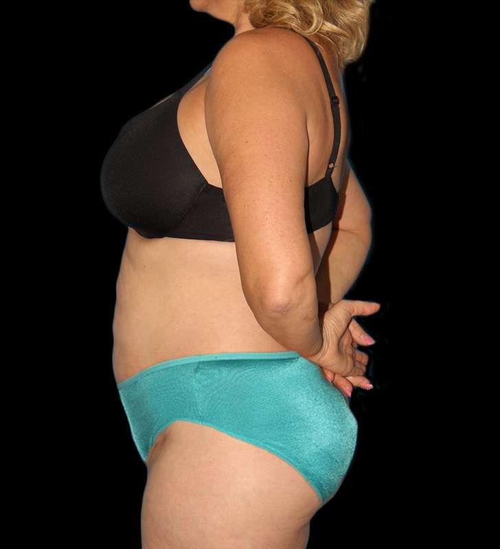 Abdominoplasty (Tummy Tuck) Before & After Patient #579