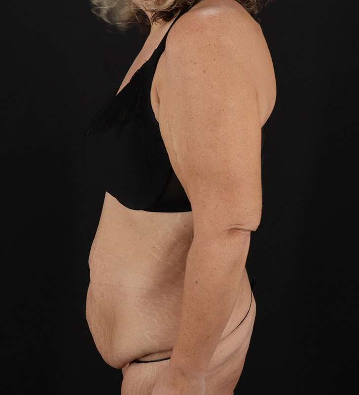 Abdominoplasty (Tummy Tuck) Before & After Patient #817