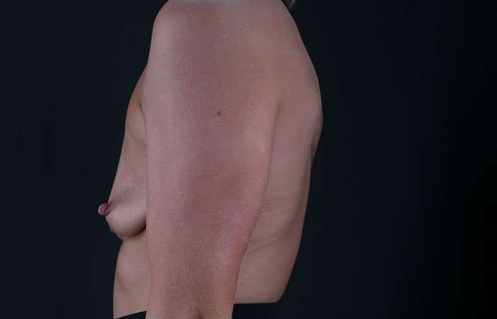 Breast Lift Before & After Patient #3750