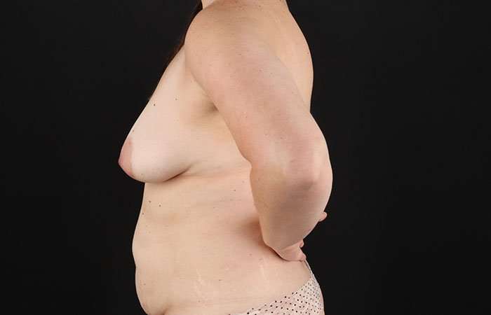Breast Lift Before & After Patient #3796