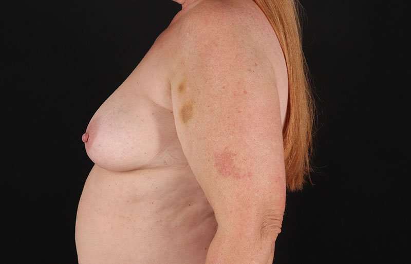 Breast Lift Before & After Patient #3809