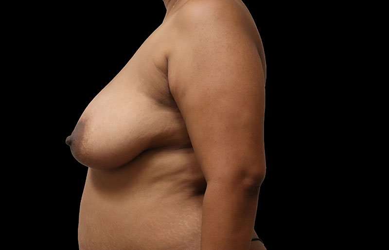 Breast Lift Before & After Patient #3820
