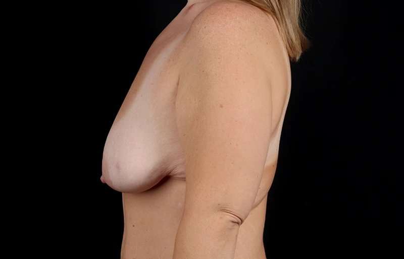 Breast Lift Before & After Patient #3831