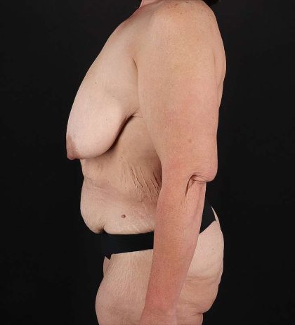 Breast Lift Before & After Patient #3853