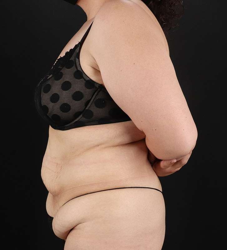 Abdominoplasty (Tummy Tuck) Before & After Patient #830