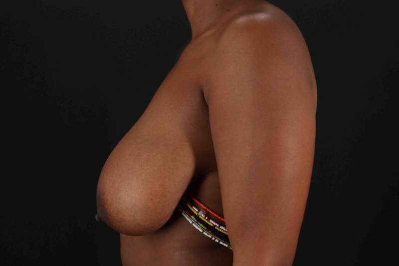 Breast Lift Before & After Patient #3875