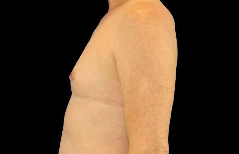 Male To Female Breast Before & After Patient #3911