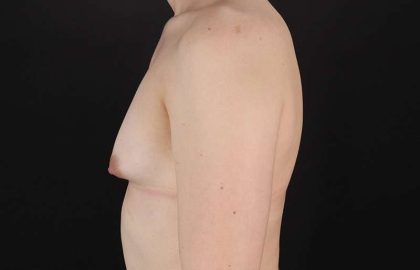 Male To Female Breast Before & After Patient #3933