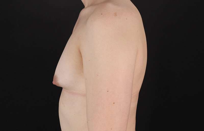 Male To Female Breast Before & After Patient #3933