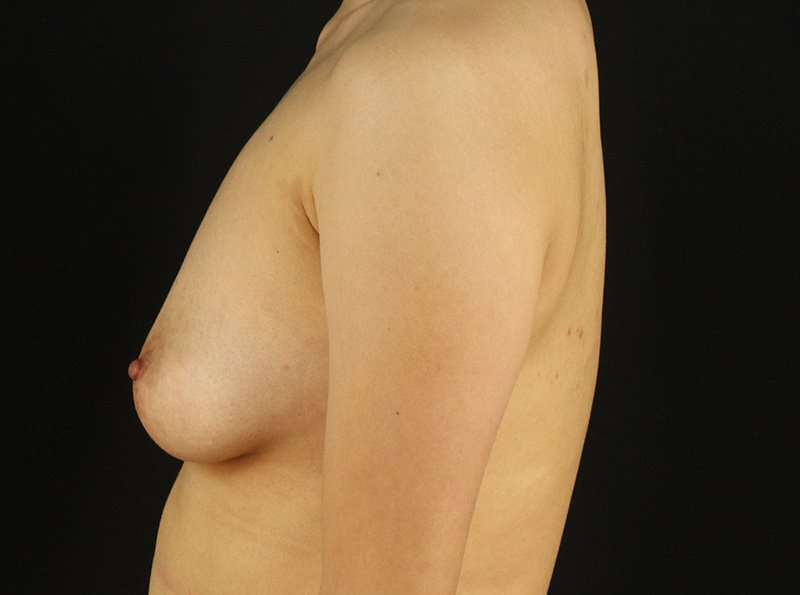 Female To Male Breast Before & After Patient #3944