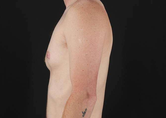 Female To Male Breast Before & After Patient #3955