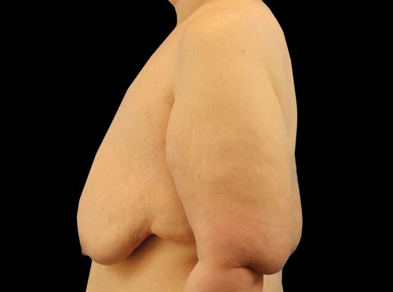 Female To Male Breast Before & After Patient #3966