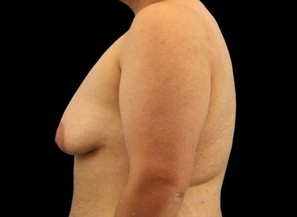 Female To Male Breast Before & After Patient #3977