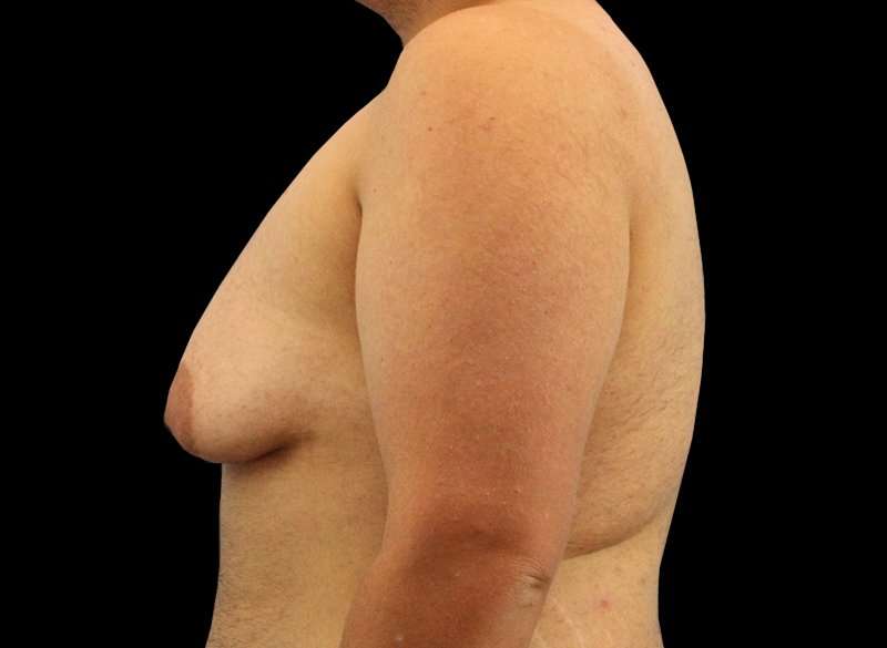 Female To Male Breast Before & After Patient #3977
