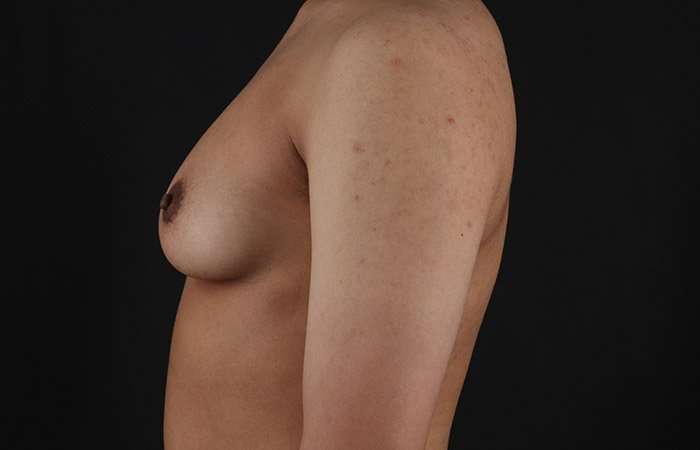 Female To Male Breast Before & After Patient #4020