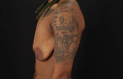 Female To Male Breast Before & After Patient #4053