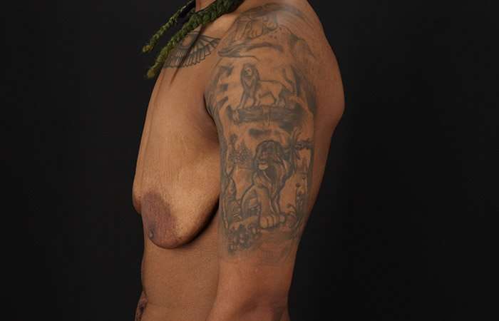Female To Male Breast Before & After Patient #4053