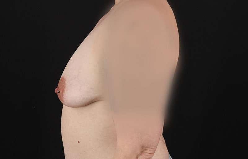 Female To Male Breast Before & After Patient #4064